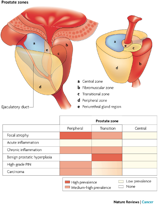 Inflammation in prostate carcinogenesis