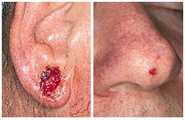 basal cell carcinoma