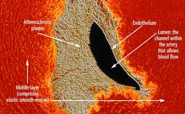 plaque on endothelium