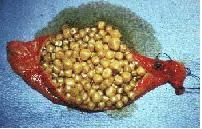 gallstones in gall bladder