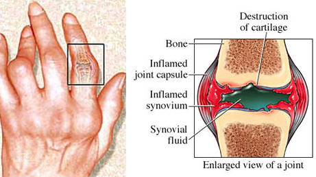 destruction of cartilage in arthritic joint