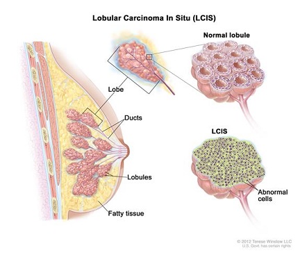 lobular carcinoma
