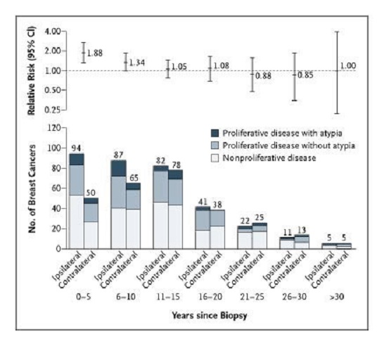 bopsies and risk of breast cancer