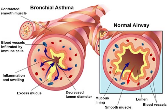 bronchial asthma vs normal airway