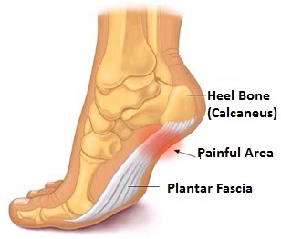 plantar fasciitis pain in arch of sole