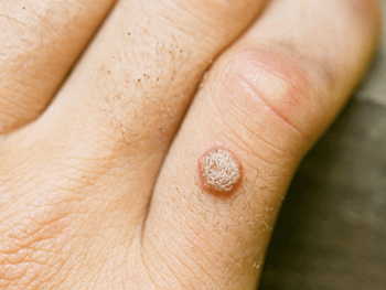 wart on finger