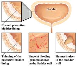 pinpoint bleeding on bladder wall